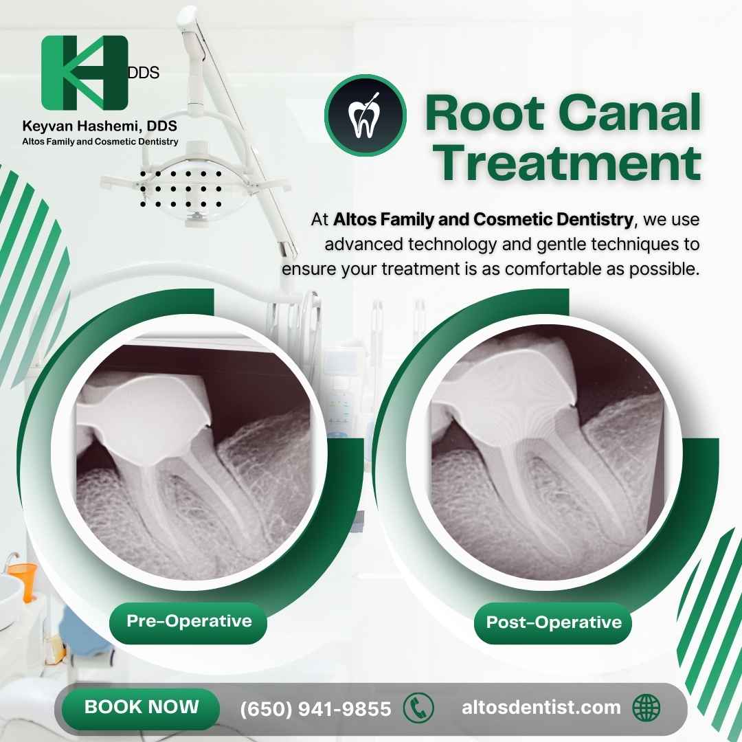 Root-Canal-Altos-Dentist