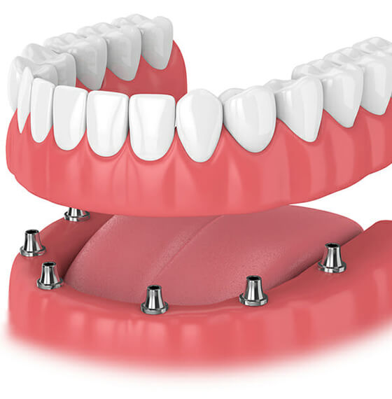 Dentures-altos-family-and-cosmetic-dentistry